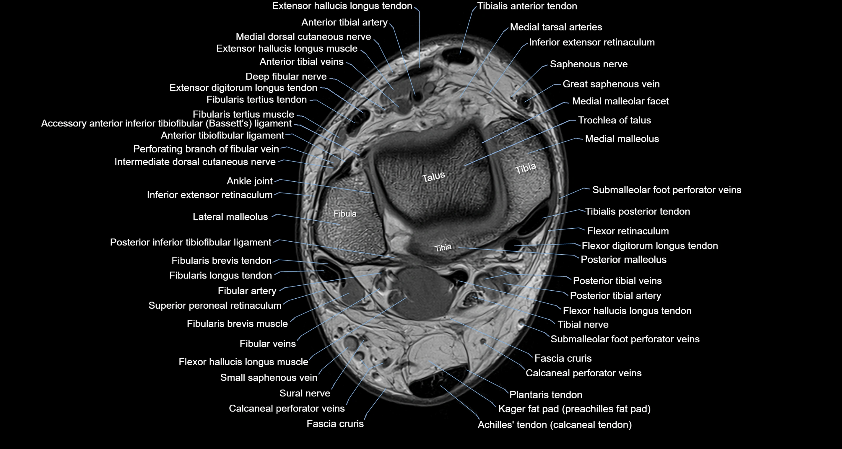 Ankle axial anatomy 3T MRI images -img-10001-00013.webp